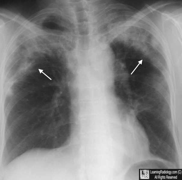 Loffler (Loeffler) Syndrome